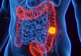 Por que câncer colorretal, que matou Preta Gil, cresce 'assustadoramente' em pessoas de até 50 anos