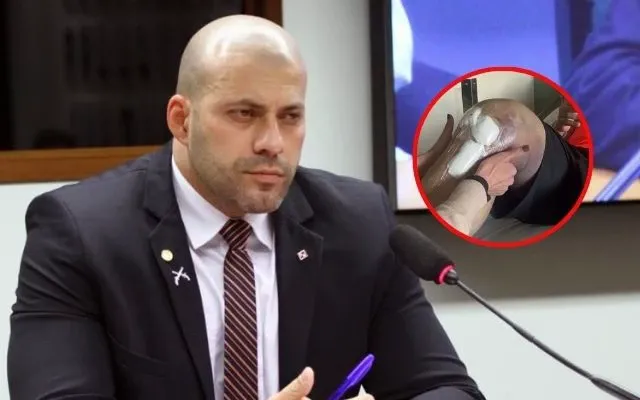 Advogado mostra foto da perna de Daniel Silveira após cirurgia