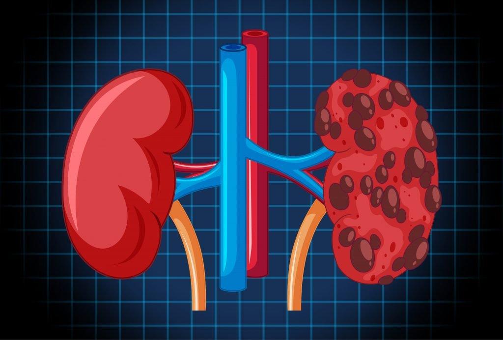Insuficiência renal: o que é, sintomas, causas e tratamento