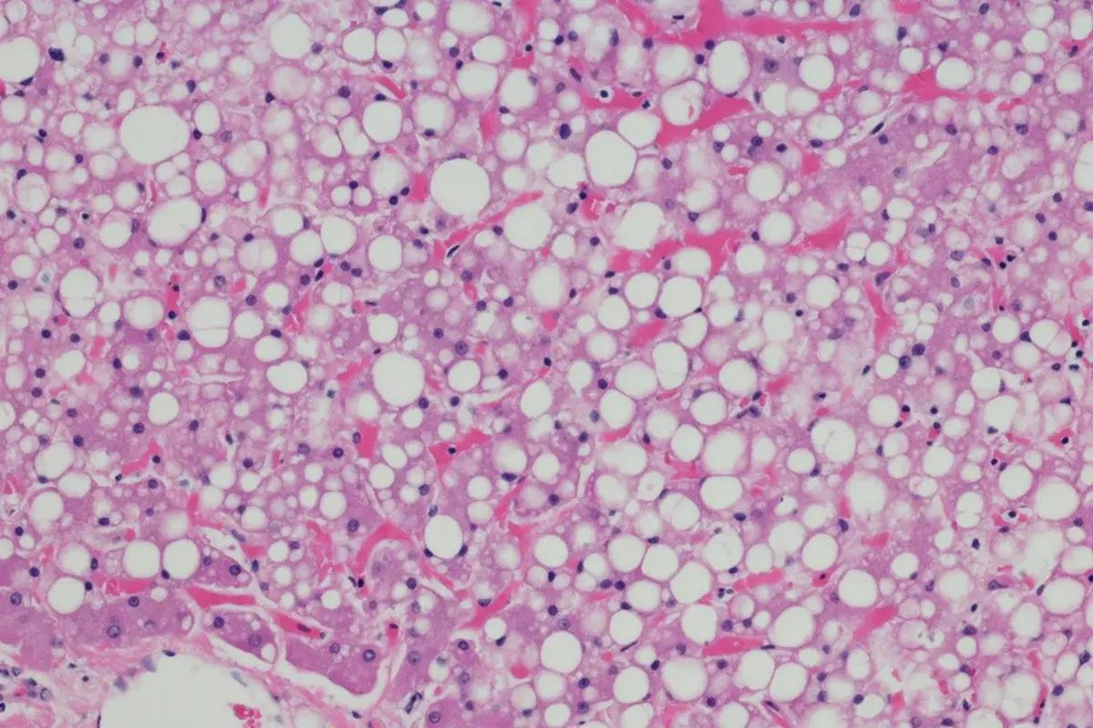 Confira uma lista de hábitos simples para tratar a gordura no fígado