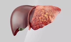 Gordura no fígado: endocrinologista diz qual é o melhor tratamento