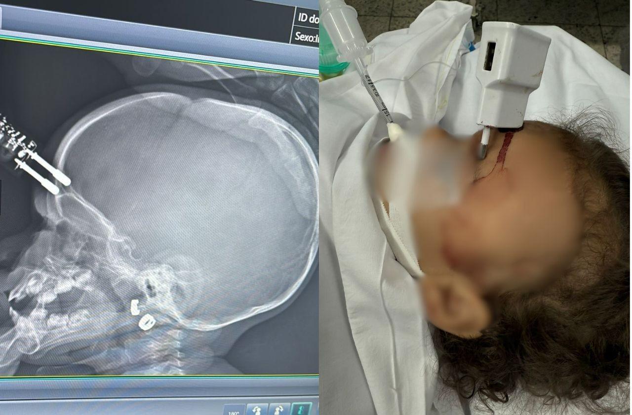 Bebê de 1 ano passa por cirurgia após carregador de celular perfurar seu crânio em MG