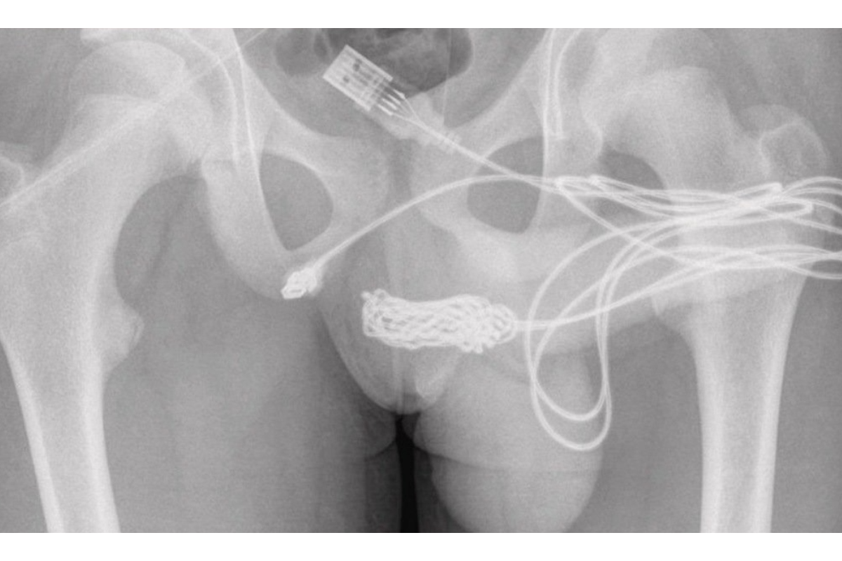 Ímãs, isqueiros e colheres: banco de dados dos EUA revela os objetos mais inusitados já inseridos em órgãos sexuais femininos e masculinos