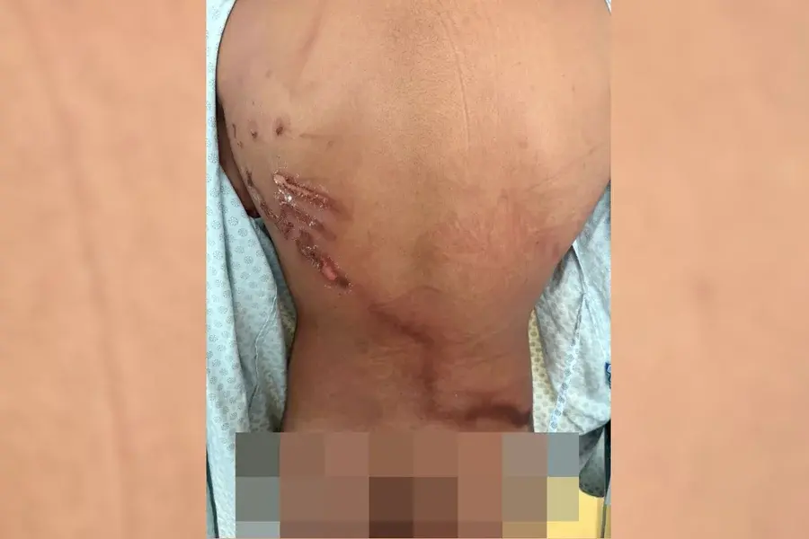 Jovem que teve costas rasgadas por raio em ato de Nikolas: “Achei que tinha 1h de vida”. Veja vídeo