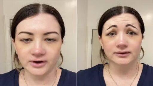 Botox mal aplicado deixa mulher com expressão comparada à máscara de ‘Pânico’