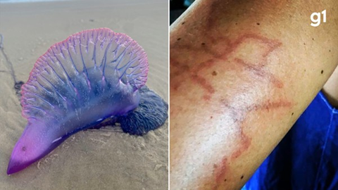 Caravelas-portuguesas causam mais de 500 queimaduras em um dia em praia do RS; saiba o que fazer em caso de contato com a pele