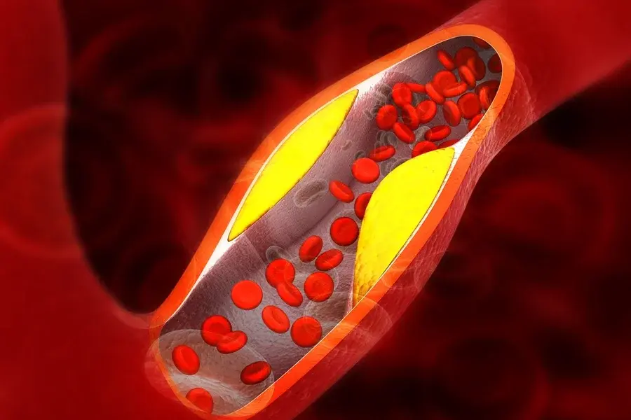 Cardiologistas explicam os principais sintomas de gordura nas artérias