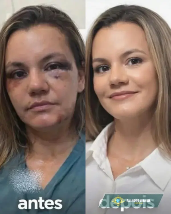 Mulher agredida com 60 socos mostra resultado de cirurgias no rosto