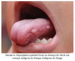 'Quase perdi a língua por um câncer e agora alerto outros homens sobre o risco do HPV'