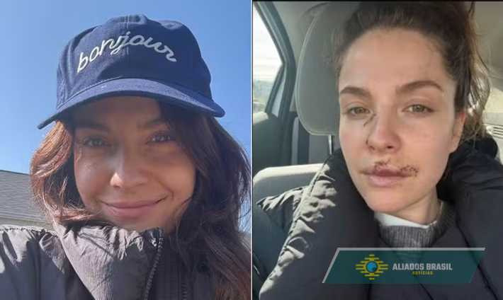 Atriz conta que teve parte do rosto arrancada em ataque de cachorro e mostra imagem de sua recuperação