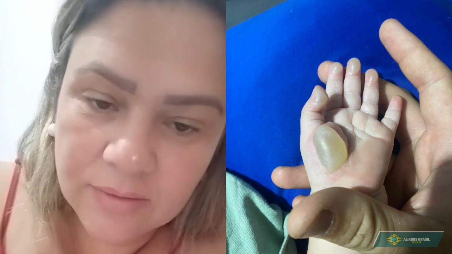 Bebê tem queimadura na mão dentro de creche e família se revolta em SC
