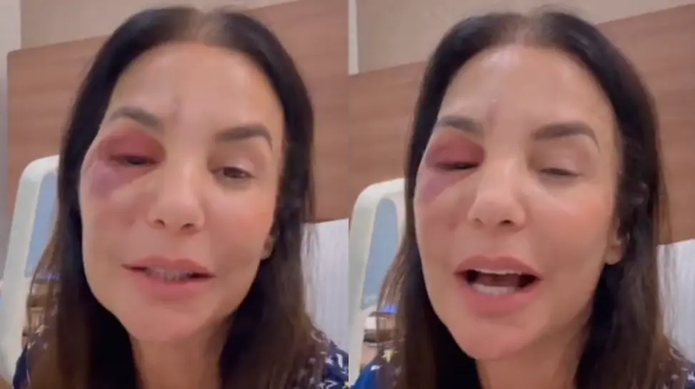 Ivete Sangalo mostra inchaço no rosto após cirurgia