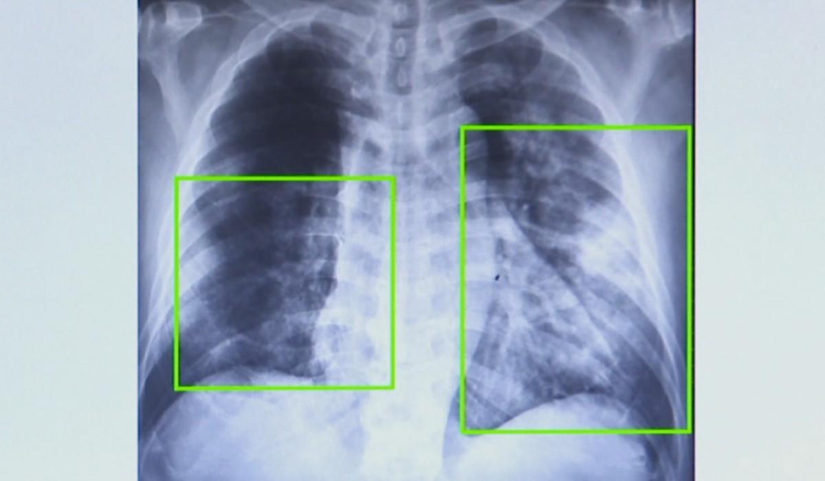 Broncopneumonia bacteriana bilateral é grave? Entenda quadro que causou internação de Bolsonaro