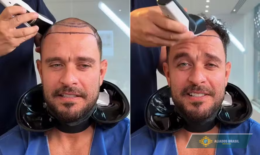 Diogo Nogueira muda visual em clínica de transplante capilar, e fãs reagem: 'Lindo de qualquer jeito'