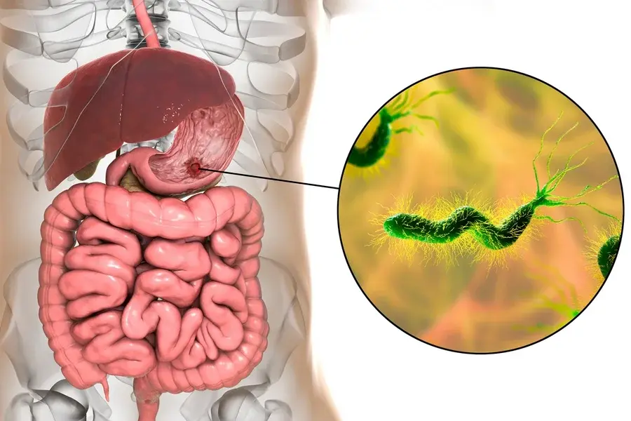 Gastroenterologista explica o que fazer para eliminar a H. pylori