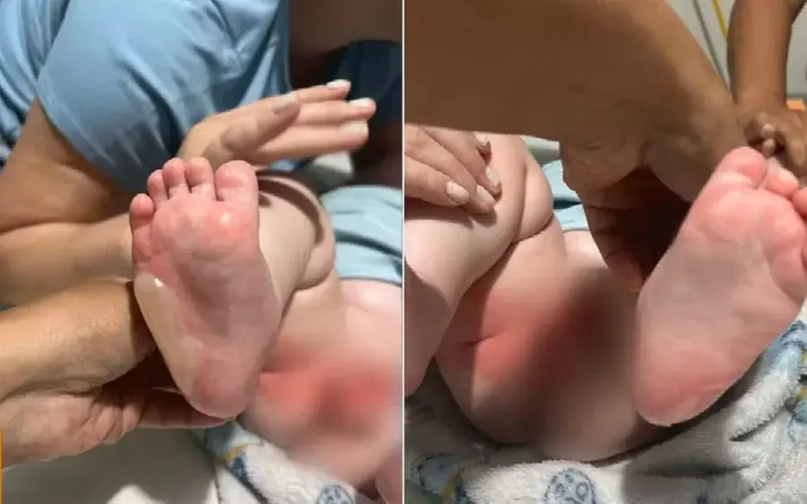 GO: bebê fica ferido após ser queimado durante banho em berçário