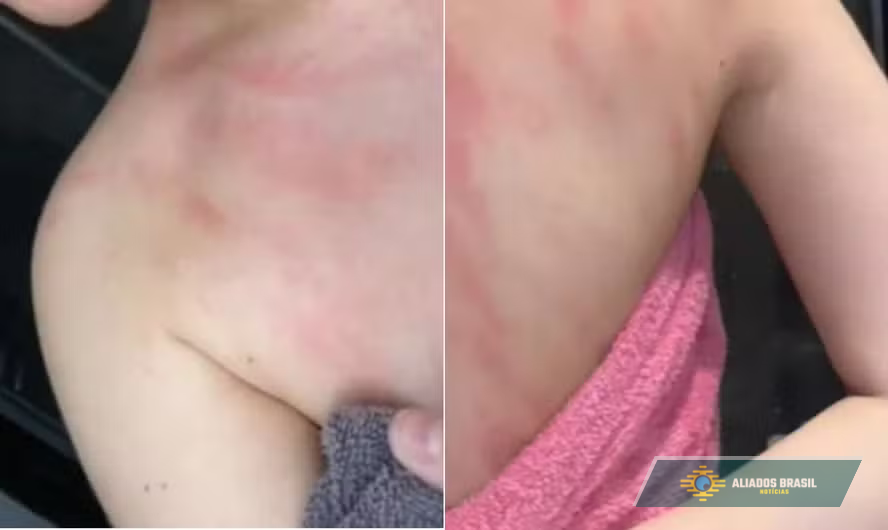 Mulher alérgica à água diz sentir dores intensas ao tomar banho; entenda o problema