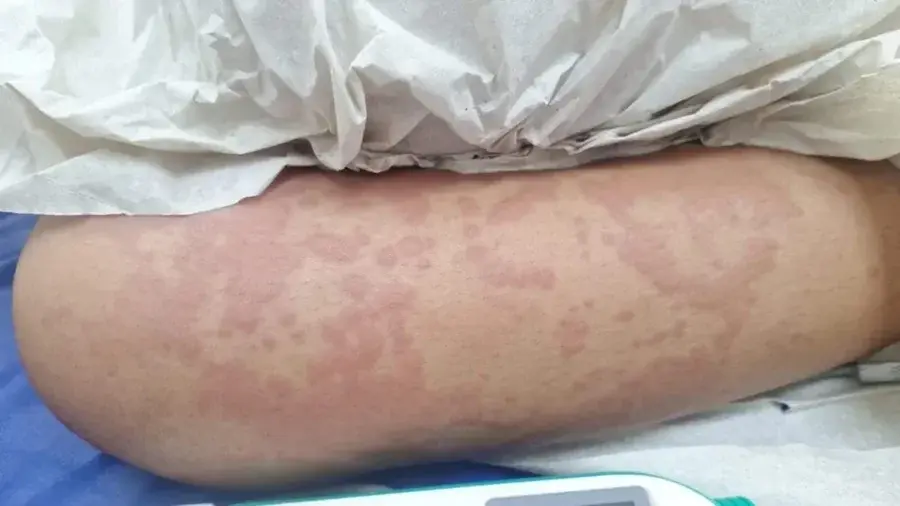 Exame aponta que detergente Ypê não causou doença em menina de 10 anos