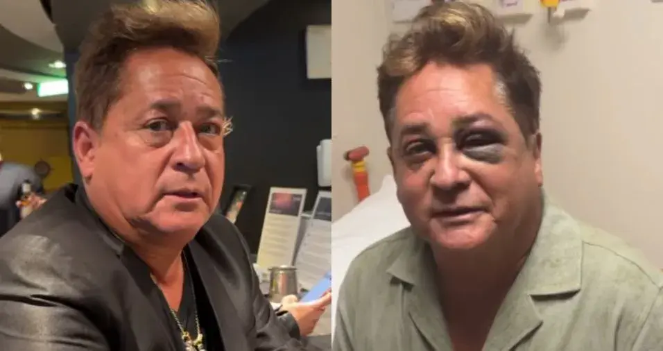 Leonardo explica acidente em pescaria que causou fratura no rosto