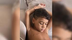 Menino de 6 anos descobre câncer raro após fortes dores no braço: 'Achei que fosse desculpa para não fazer tarefa', diz mãe