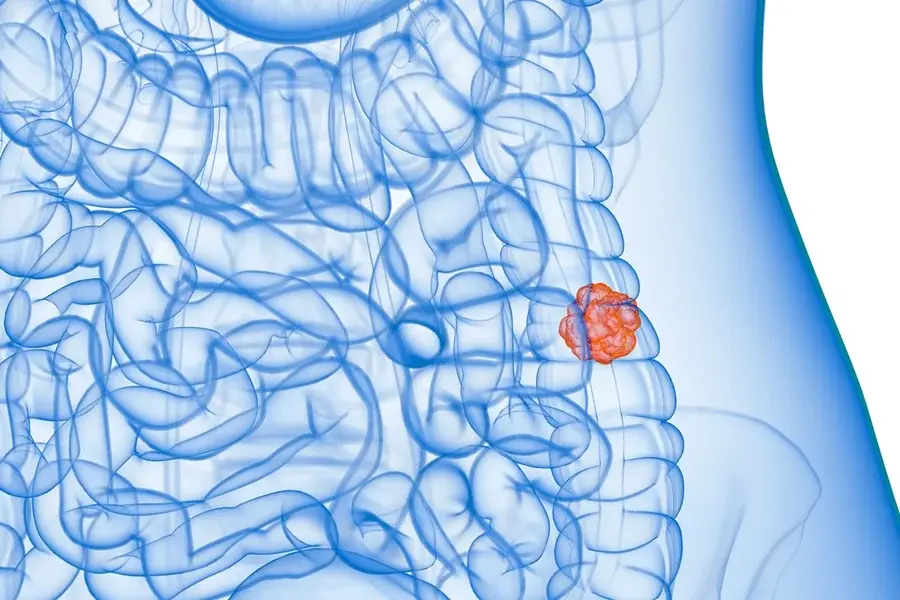 SUS adotará exame não invasivo para identificar câncer de intestino