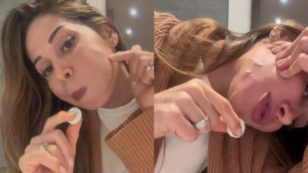 Maíra Cardi expõe sequelas de aplicação no rosto com PMMA
