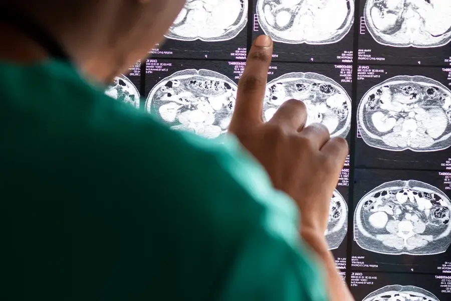 Medicamento contra vermes pode ajudar a tratar câncer cerebral