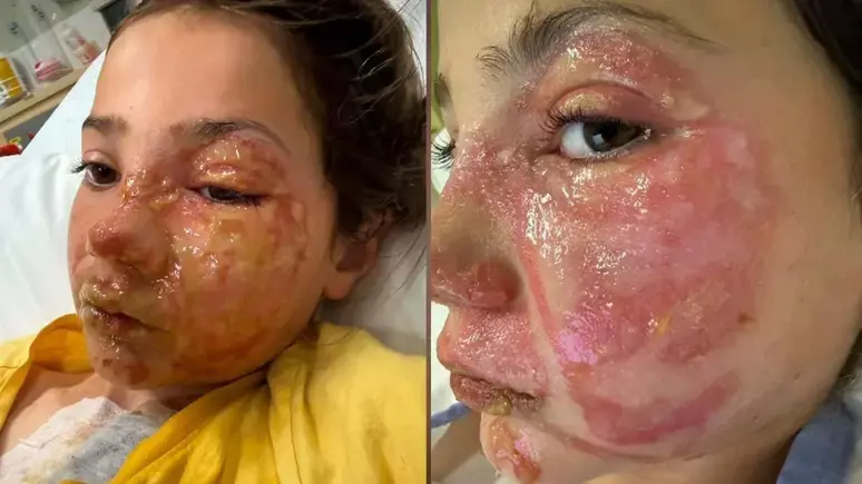 Menina de 10 anos sofre queimaduras graves no rosto após reproduzir desafio viral de rede social  