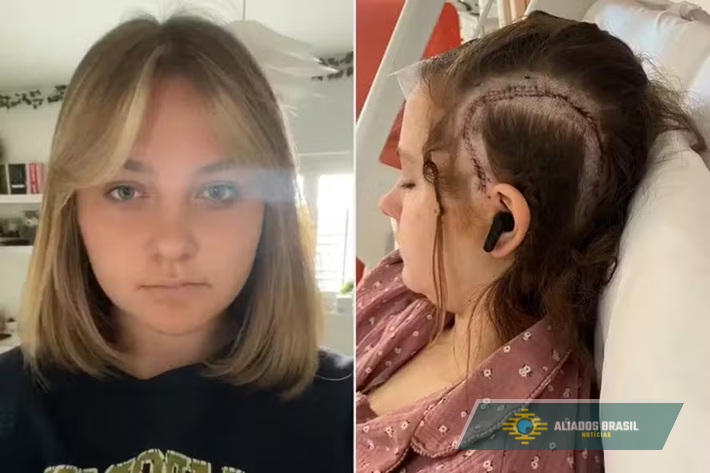 Adolescente se torna paciente mais jovem a passar por cirurgia cerebral acordada