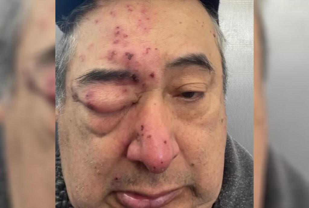 Homem é atacado por ratos e fica com o rosto desfigurado: ‘Estava dormindo’