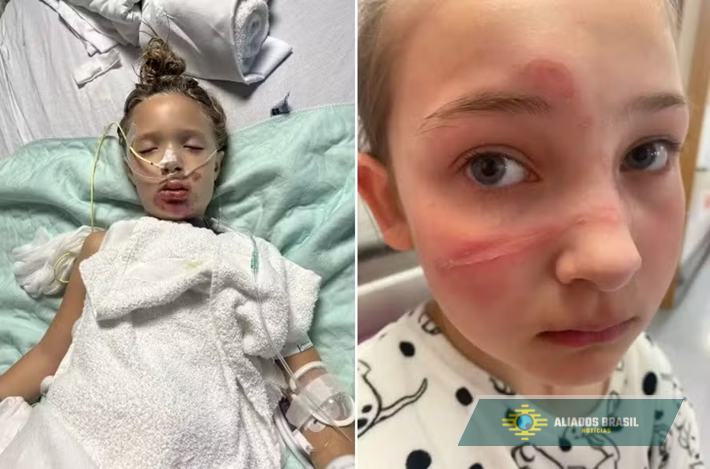Número de acidentes com explosão de brinquedo em trend viral se multiplica. Imagens fortes