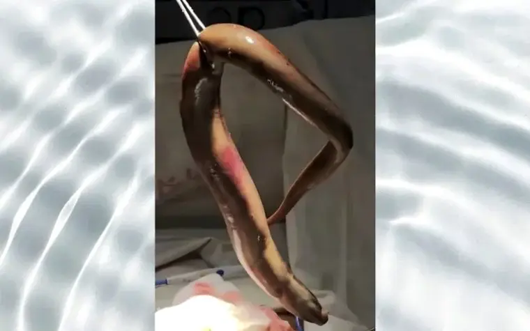 Pescador é internado em estado grave após enguia de 65 cm ser encontrada alojada em seu reto