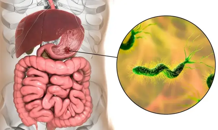 Gastroenterologista explica o que fazer para eliminar a H. pylori