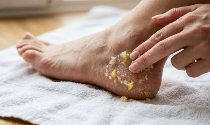 Receita caseira para os pés vira alvo de alerta; entenda os riscos do açúcar com limão