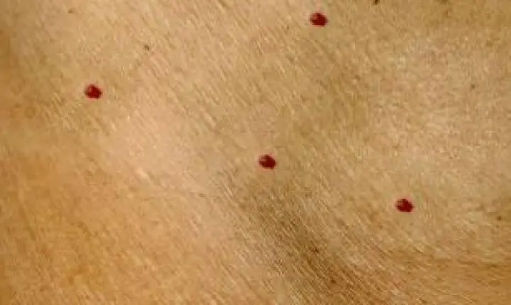 O que são os “pontinhos vermelhos” que aparecem na pele e quando eles representam um sinal de alerta?