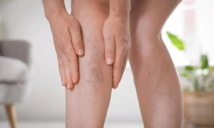Pernas inchadas? Médico explica como o frio pode afetar a circulação